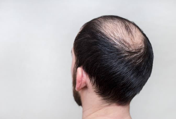 Cegah Kebotakan dan Jaga Kesehatan Rambut Kepala Dengan 6 Bahan Alami ini Cegah Kebotakan Rambut